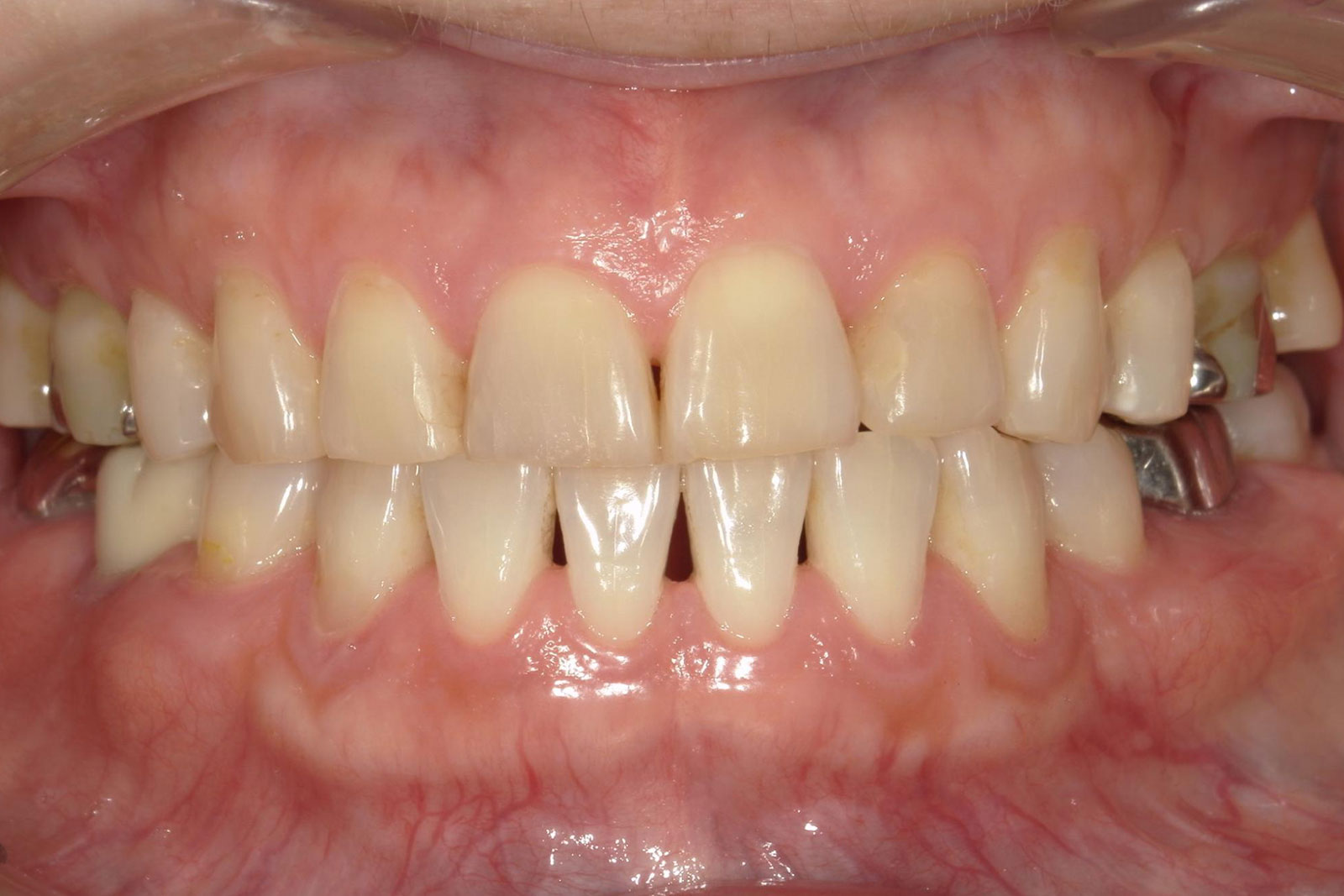 治療前